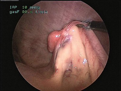 Ovariectomía laparoscópica: una alternativa mínimamente invasiva para la esterilización